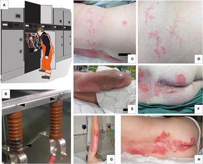 Case Report: Unravelling the Mysterious Lichtenberg Figure Skin Response in a Patient With a High-Voltage Electrical Injury